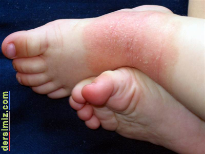 Dermatit Nedir?
