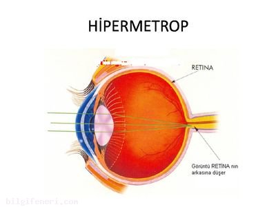 Hipermetrop Nedir?