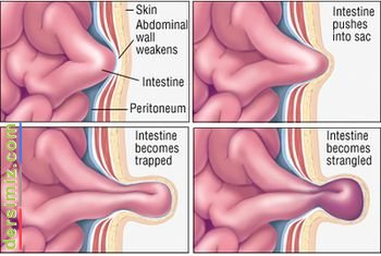 Fıtık Nedir?