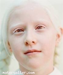 Albinizm Nedir?